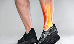 High Ankle Sprains: Why They Can Take Longer to Heal