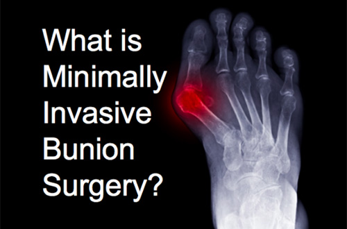 Minimally Invasive Bunion Surgery